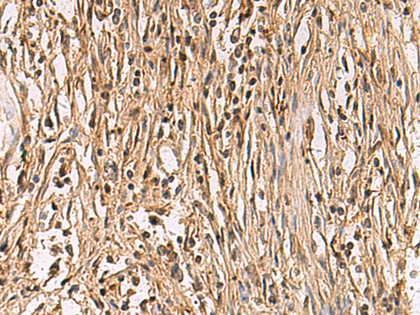 Immunohistochemistry of paraffin-embedded Human colorectal cancer tissue  using ENTPD1 Polyclonal Antibody at dilution of 1:60(?200)