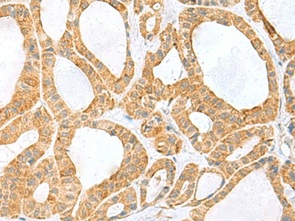 Immunohistochemistry of paraffin-embedded Human thyroid cancer tissue  using PPIH Polyclonal Antibody at dilution of 1:60(?200)