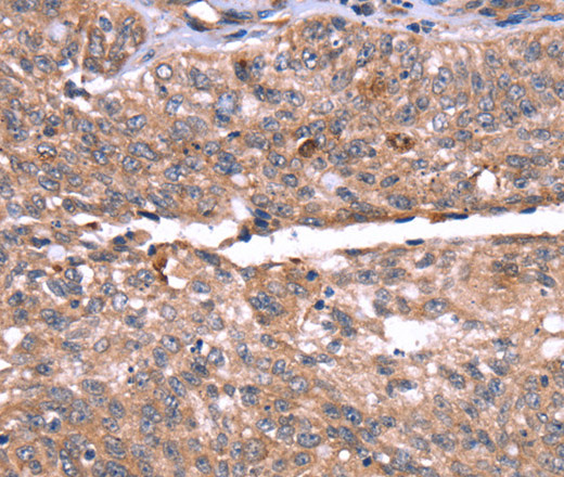 Immunohistochemistry of paraffin-embedded Human ovarian cancer tissue using HRG Polyclonal Antibody at dilution 1:50