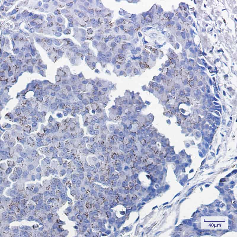 Immunohistochemistry of Smad3 in paraffin-embedded Human breast cancer tissue using Smad3 Rabbit mAb at dilution 1:100