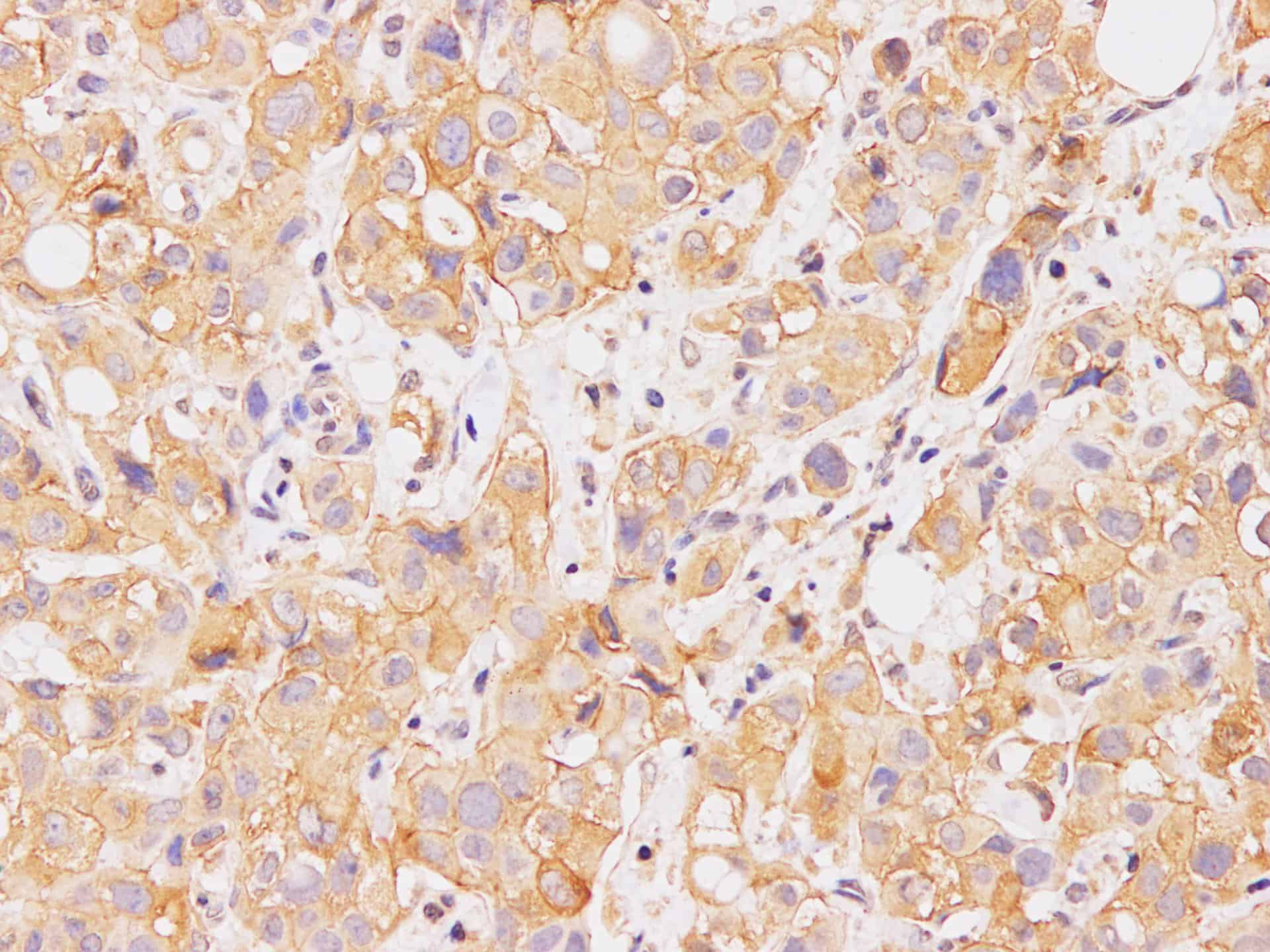 Immunohistochemistry of paraffin-embedded Human breast cancer using E-Cadherin Polyclonal Antibody at dilution of 1:100