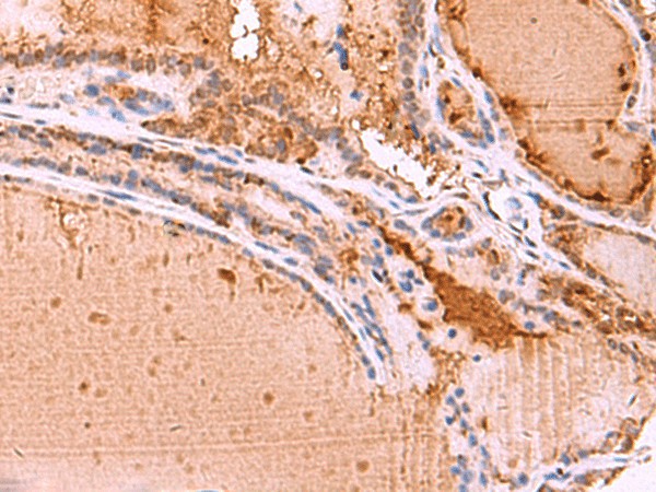 Immunohistochemistry of paraffin-embedded Human thyroid cancer tissue  using HTRA4 Polyclonal Antibody at dilution of 1:35(?200)