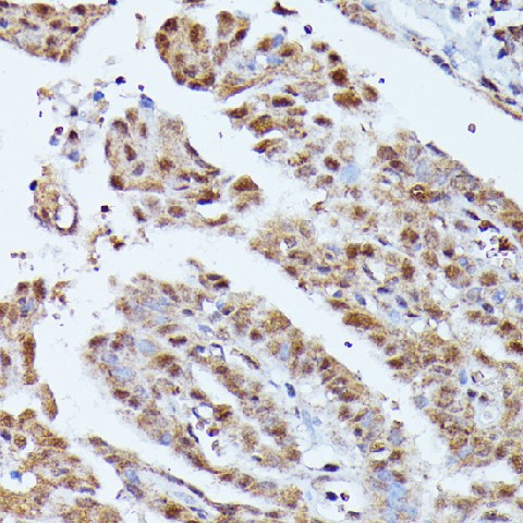 Immunohistochemistry of paraffin-embedded Human thyroid cancer using KIAA1429 Polyclonal Antibody at dilution of  1:100 (40x lens).