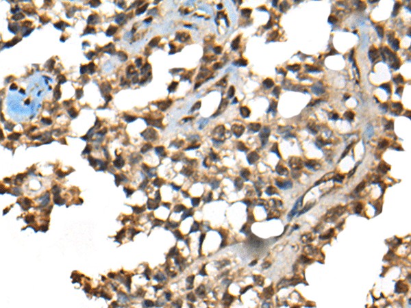 Immunohistochemistry of paraffin-embedded Human ovarian cancer tissue  using CCDC12 Polyclonal Antibody at dilution of 1:50(?200)