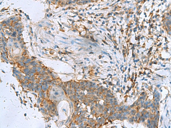 Immunohistochemistry of paraffin-embedded Human esophagus cancer tissue  using RPL10A Polyclonal Antibody at dilution of 1:50(?200)