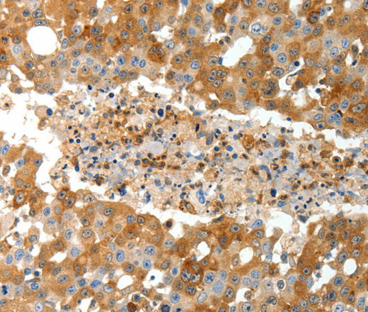 Immunohistochemistry of paraffin-embedded Human breast cancer tissue using TEP1 Polyclonal Antibody at dilution 1:40