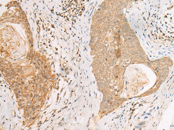 Immunohistochemistry of paraffin-embedded Human esophagus cancer tissue  using PAX5 Polyclonal Antibody at dilution of 1:30(?200)