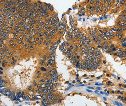 Immunohistochemistry of paraffin-embedded Human colon cancer tissue using GluR2 Polyclonal Antibody at dilution 1:70