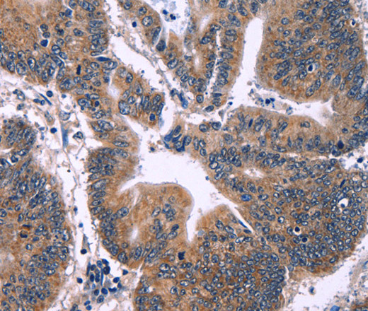 Immunohistochemistry of paraffin-embedded Human colon cancer tissue using ING2 Polyclonal Antibody at dilution 1:60