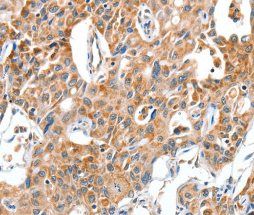 Immunohistochemistry of paraffin-embedded Human lung cancer using BAX Polyclonal Antibody at dilution of 1:30