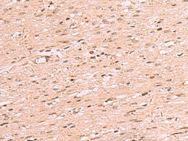 Immunohistochemistry of paraffin-embedded Human colorectal cancer tissue  using RRP8 Polyclonal Antibody at dilution of 1:70(?200)