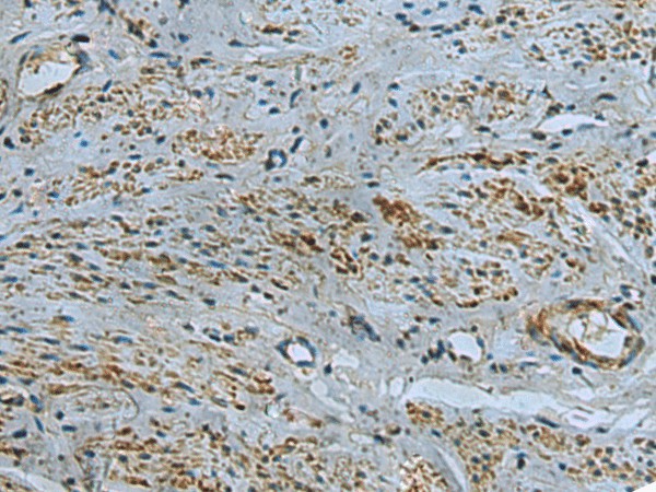 Immunohistochemistry of paraffin-embedded Human cervical cancer tissue  using IL17RD Polyclonal Antibody at dilution of 1:40(?200)