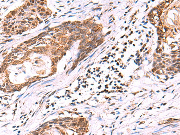 Immunohistochemistry of paraffin-embedded Human esophagus cancer tissue  using KATNAL1 Polyclonal Antibody at dilution of 1:95(?200)