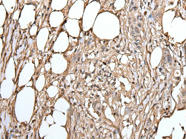 Immunohistochemistry of paraffin-embedded Human colorectal cancer tissue  using ATAD1 Polyclonal Antibody at dilution of 1:50(?200)