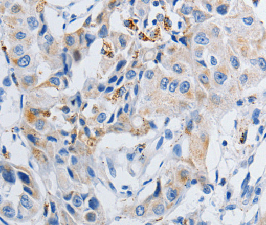 Immunohistochemistry of paraffin-embedded Human lung cancer tissue using GRIA3 Polyclonal Antibody at dilution 1:50