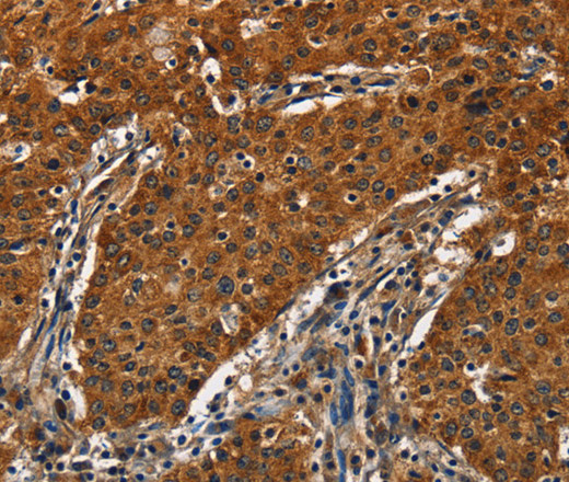 Immunohistochemistry of paraffin-embedded Human gastric cancer tissue using CATSPER4 Polyclonal Antibody at dilution 1:50