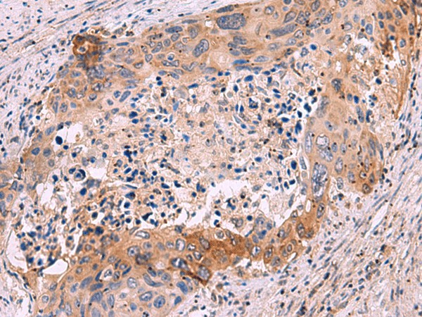 Immunohistochemistry of paraffin-embedded Human cervical cancer tissue  using GRIK4 Polyclonal Antibody at dilution of 1:50(?200)