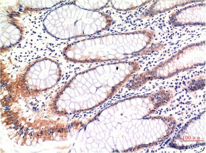 Immunohistochemistry of paraffin-embedded Human colon carcinoma tissue with Phospho-MLKL (Ser358) Monoclonal Antibody at dilution of 1:200