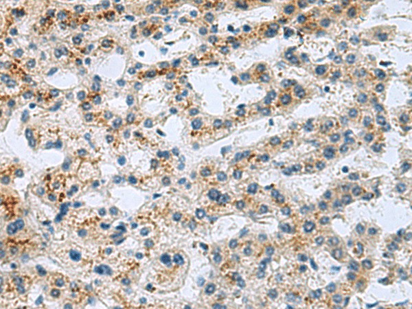 Immunohistochemistry of paraffin-embedded Human liver cancer tissue  using GHRHR Polyclonal Antibody at dilution of 1:40(?200)