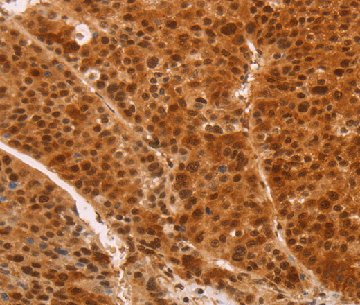 Immunohistochemistry of paraffin-embedded Human liver cancer tissue using HEXIM1 Polyclonal Antibody at dilution 1:65