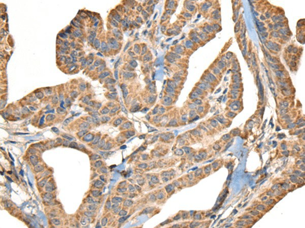 Immunohistochemistry of paraffin-embedded Human thyroid cancer tissue  using SLAMF7 Polyclonal Antibody at dilution of 1:30(?200)