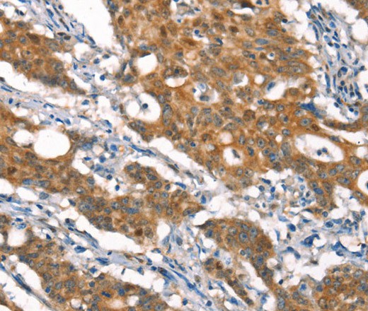 Immunohistochemistry of paraffin-embedded Human gasrtic cancer tissue using CYLD Polyclonal Antibody at dilution 1:35