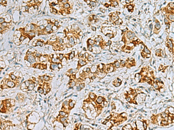 Immunohistochemistry of paraffin-embedded Human liver cancer tissue  using FAAP100 Polyclonal Antibody at dilution of 1:40(?200)