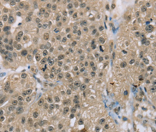 Immunohistochemistry of paraffin-embedded Human breast cancer using ACTN2 Polyclonal Antibody at dilution of 1:30