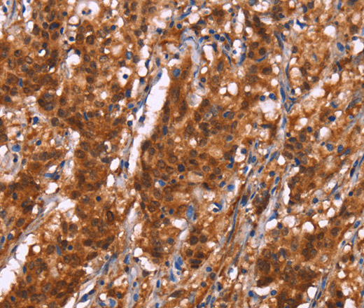 Immunohistochemistry of paraffin-embedded Human gastric cancer using BRK1 Polyclonal Antibody at dilution of 1:40