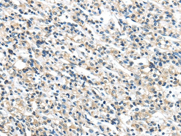 Immunohistochemistry of paraffin-embedded Human prostate cancer tissue using VPS36 Polyclonal Antibody at dilution 1:40