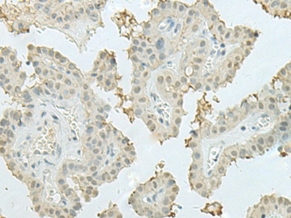 Immunohistochemistry of paraffin-embedded Human thyroid cancer tissue  using MECOM Polyclonal Antibody at dilution of 1:60(?200)