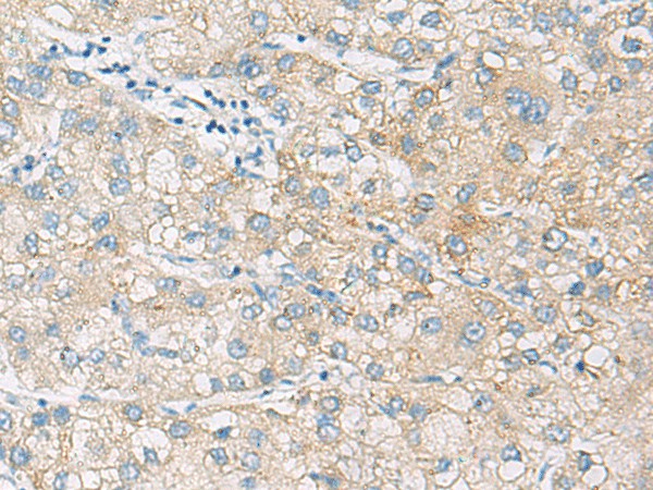 Immunohistochemistry of paraffin-embedded Human liver cancer tissue  using NCOA4 Polyclonal Antibody at dilution of 1:130(?200)