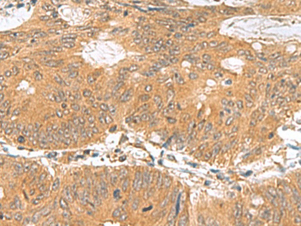 Immunohistochemistry of paraffin-embedded Human colorectal cancer tissue  using GEMIN7 Polyclonal Antibody at dilution of 1:70(?200)