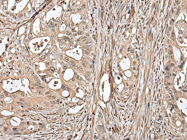 Immunohistochemistry of paraffin-embedded Human colorectal cancer tissue  using UTP3 Polyclonal Antibody at dilution of 1:50(?200)