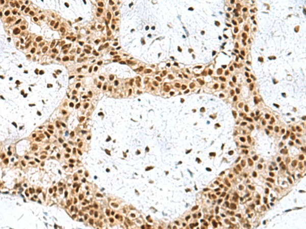 Immunohistochemistry of paraffin-embedded Human breast cancer tissue  using PRPF40A Polyclonal Antibody at dilution of 1:60(?200)