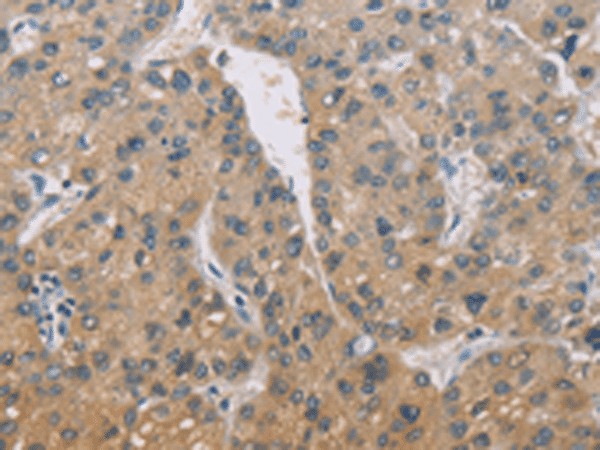 Immunohistochemistry of paraffin-embedded Human liver cancer tissue  using ZBTB6  Polyclonal Antibody at dilution of 1:50(?200)