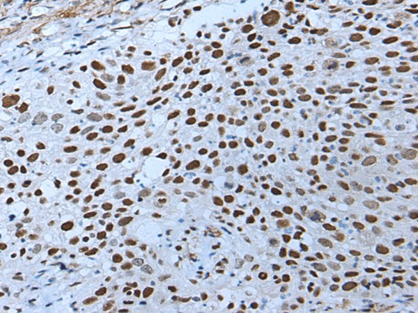 Immunohistochemistry of paraffin-embedded Human lung cancer tissue  using ZNHIT3 Polyclonal Antibody at dilution of 1:80(?200)