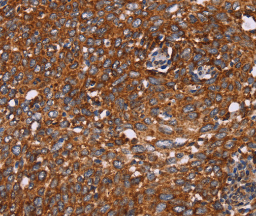 Immunohistochemistry of paraffin-embedded Human cervical cancer tissue using CYP2W1 Polyclonal Antibody at dilution 1:60