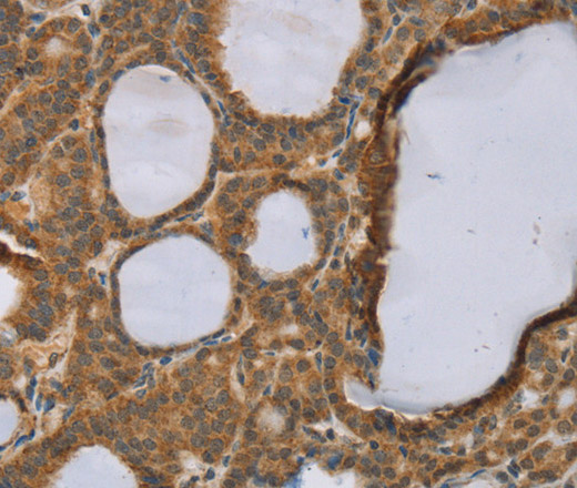 Immunohistochemistry of paraffin-embedded Human thyroid cancer using RNF5 Polyclonal Antibody at dilution of 1:35