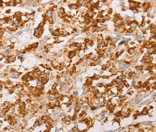 Immunohistochemistry of paraffin-embedded Human thyroid cancer using AK2 Polyclonal Antibody at dilution of 1:30