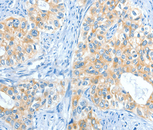 Immunohistochemistry of paraffin-embedded Human cervical cancer tissue using COL4A2 Polyclonal Antibody at dilution 1:70