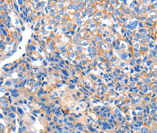 Immunohistochemistry of paraffin-embedded Human breast cancer tissue using HCN2 Polyclonal Antibody at dilution 1:80