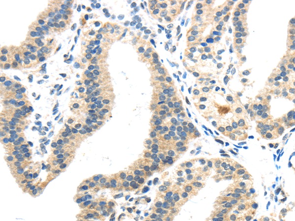 Immunohistochemistry of paraffin-embedded Human thyroid cancer using INHBB Polyclonal Antibody at dilution of  1/40