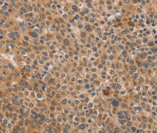 Immunohistochemistry of paraffin-embedded Human liver cancer using CDK11B Polyclonal Antibody at dilution of 1:40