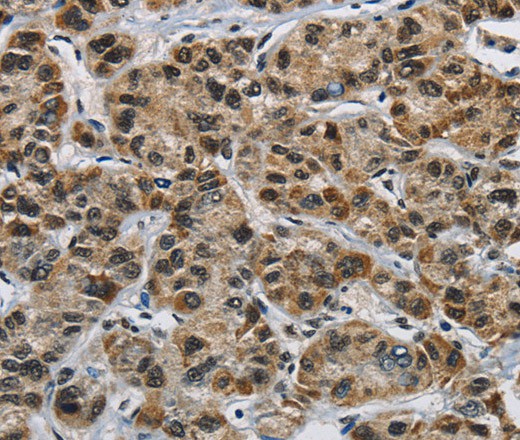 Immunohistochemistry of paraffin-embedded Human liver cancer using HNRNP L Polyclonal Antibody at dilution of 1:40