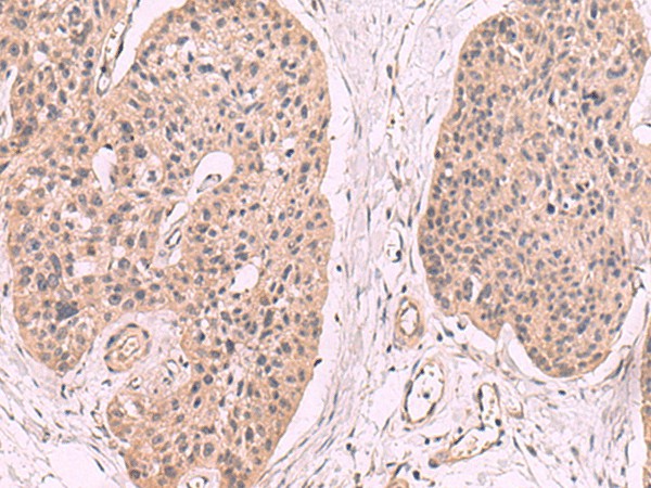 Immunohistochemistry of paraffin-embedded Human esophagus cancer tissue  using KLRB1 Polyclonal Antibody at dilution of 1:55(?200)