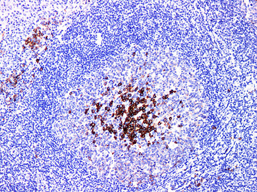 Immunohistochemistry of paraffinembedded Human tonsil tissue with CD38 Monoclonal Antibody(Antigen repaired by EDTA).