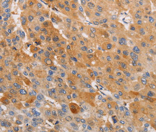 Immunohistochemistry of paraffin-embedded Human liver cancer tissue using OLR1 Polyclonal Antibody at dilution 1:50