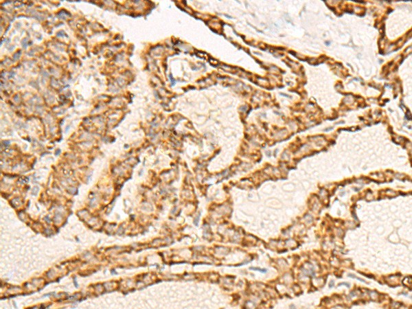 Immunohistochemistry of paraffin-embedded Human thyroid cancer tissue  using ATP5I Polyclonal Antibody at dilution of 1:30(?200)