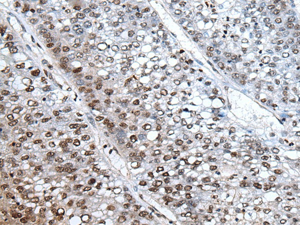 Immunohistochemistry of paraffin-embedded Human liver cancer tissue  using HIST1H3A Polyclonal Antibody at dilution of 1:30(?200)